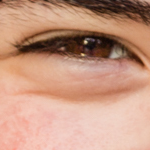 Eye Bags